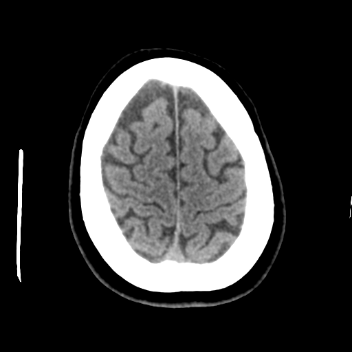 Cerebellar metastasis (cystic appearance) (Radiopaedia 41395-44258 Axial non-contrast 45).png