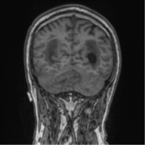 Cerebellar metastasis from lung adenocarcinoma (Radiopaedia 86690-102829 Coronal T1 26).png