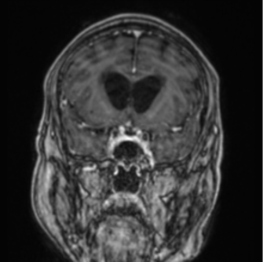 Cerebellar metastasis from lung adenocarcinoma (Radiopaedia 86690-102829 Coronal T1 C+ 64).png