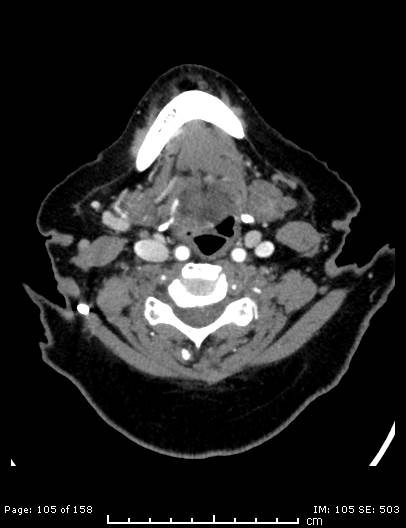 Cerebellar strokes due to intracranial giant cell arteritis (Radiopaedia 68799-78510 CT angiogram 105).jpg