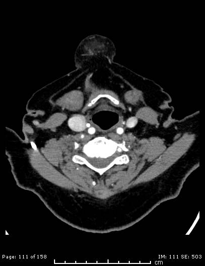 Cerebellar strokes due to intracranial giant cell arteritis (Radiopaedia 68799-78510 CT angiogram 111).jpg