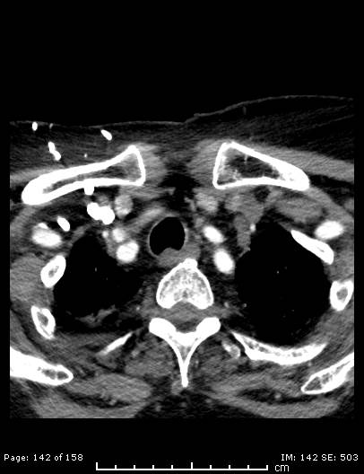 File:Cerebellar strokes due to intracranial giant cell arteritis (Radiopaedia 68799-78510 CT angiogram 142).jpg