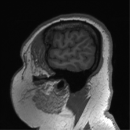 Cerebellopontine angle meningioma (Radiopaedia 48434-53348 Sagittal T1 78).png