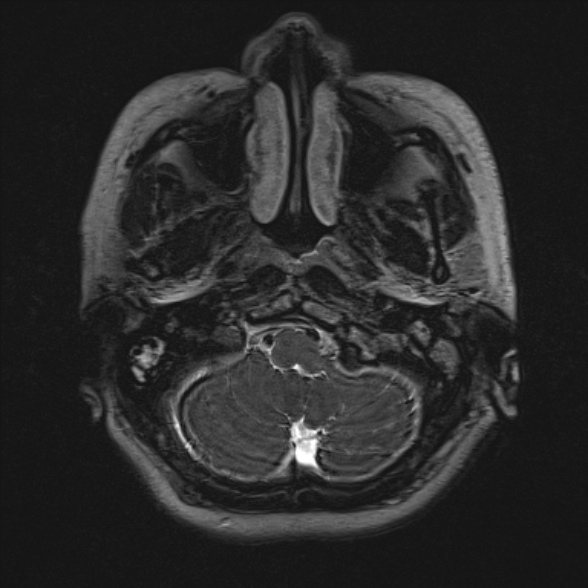 Cerebellopontine angle meningioma (Radiopaedia 53561-59591 Axial 3D volume T2 22).jpg