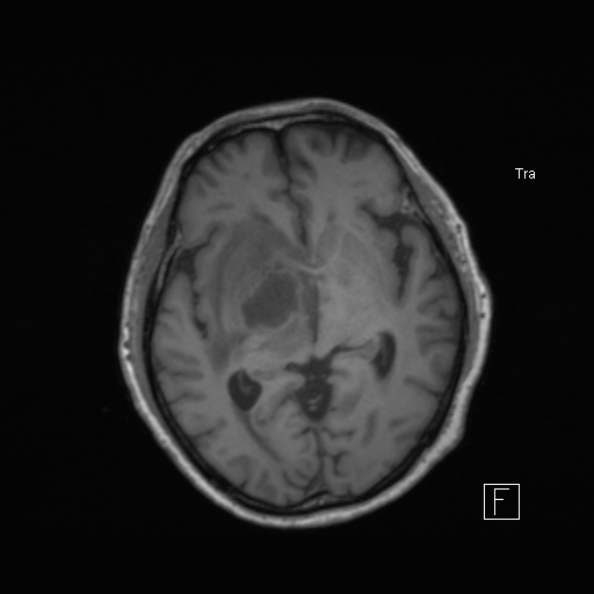 Cerebral abscess (Radiopaedia 26111-26247 Axial T1 31).jpg
