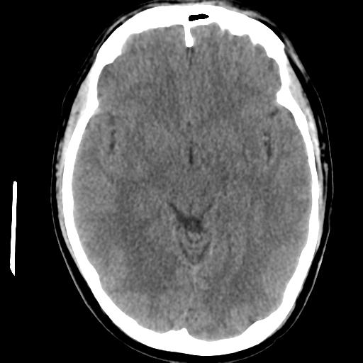 Cerebral abscess (Radiopaedia 29451-29919 Axial non-contrast 22).jpg