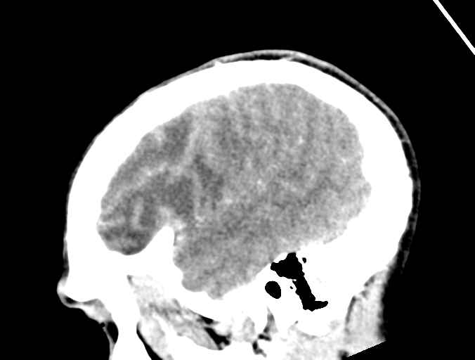 Cerebral abscess (Radiopaedia 60342-68008 Sagittal C+ delayed 42).png