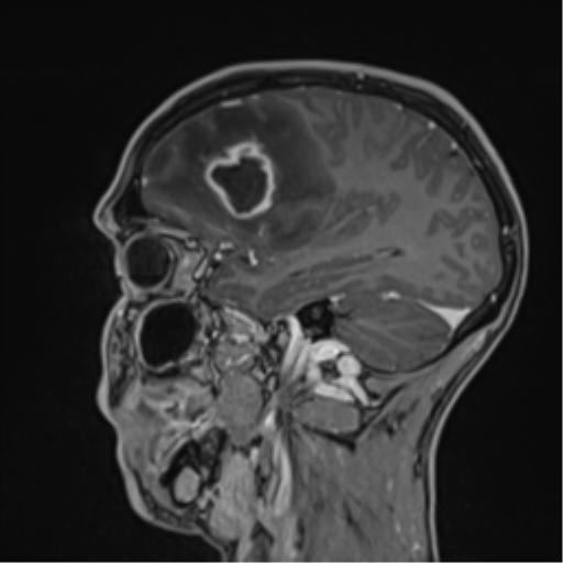 Cerebral abscess (Radiopaedia 60342-68009 J 40).png
