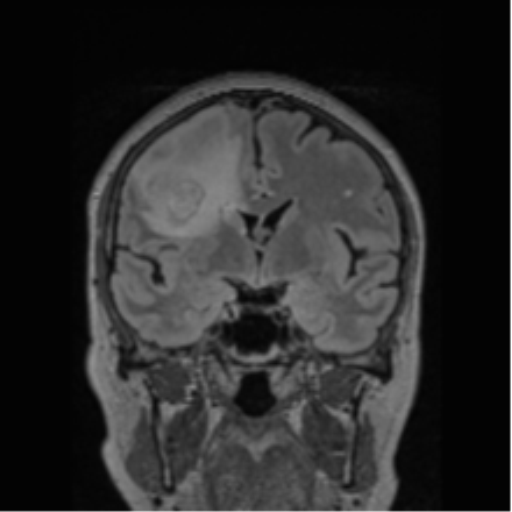 Cerebral abscess from pulmonary arteriovenous malformation (Radiopaedia 86275-102291 Coronal FLAIR 52).png