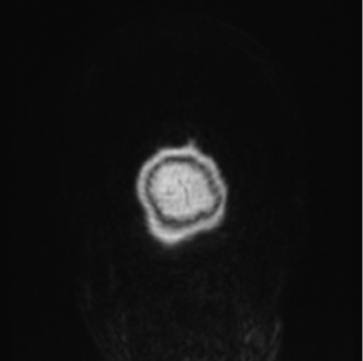 File:Cerebral abscess from pulmonary arteriovenous malformation (Radiopaedia 86275-102291 L 1).png