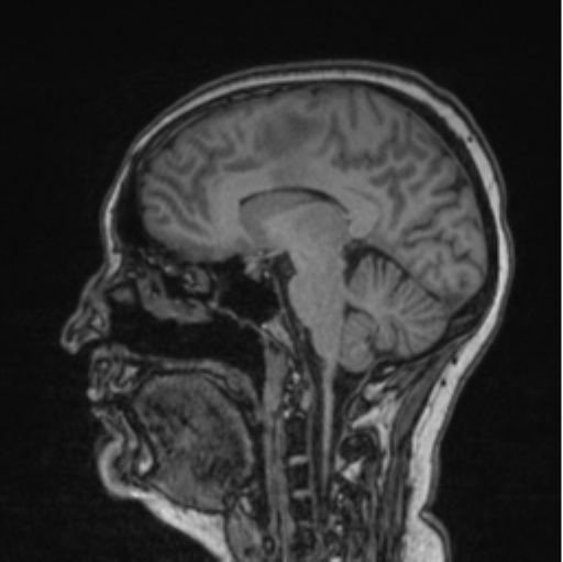 Cerebral abscess from pulmonary arteriovenous malformation (Radiopaedia 86275-102291 Sagittal T1 56).png