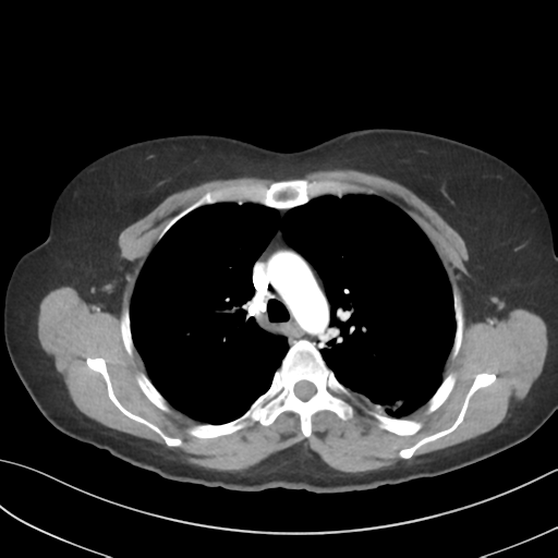 File:Cerebral abscess from pulmonary arteriovenous malformation (Radiopaedia 86275-102292 A 21).png