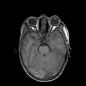 File:Cerebral abscess post cardiac surgery (Radiopaedia 27244-27420 Axial T1 8).jpg