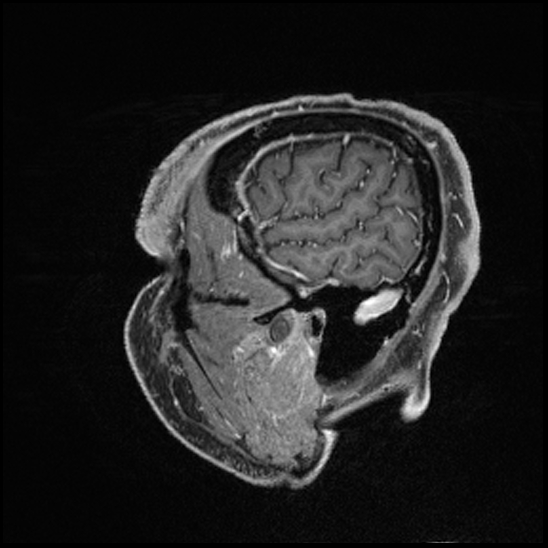 Cerebral abscess with ventriculitis (Radiopaedia 78965-91878 Sagittal T1 C+ 28).jpg