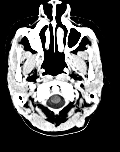 Cerebral abscesses (Radiopaedia 70458-80568 Axial Contrast 9).jpg