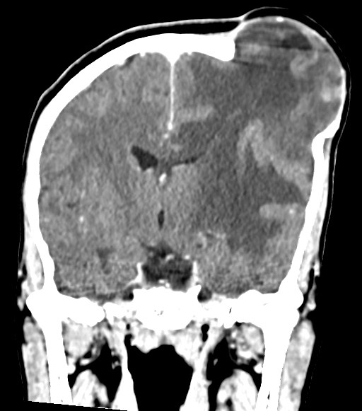 File:Cerebral abscesses (Radiopaedia 70458-80568 Coronal Contrast 34).jpg