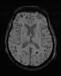 Cerebral amyloid angiopathy-related inflammation (Radiopaedia 74836-85849 Axial SWI 41).jpg