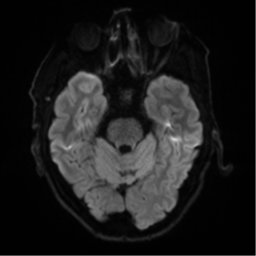 Cerebral amyloid angiopathy (Radiopaedia 46082-50433 Axial DWI 35).png