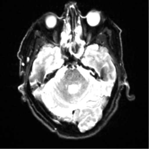 File:Cerebral amyloid angiopathy (Radiopaedia 46082-50433 Axial DWI 7).png