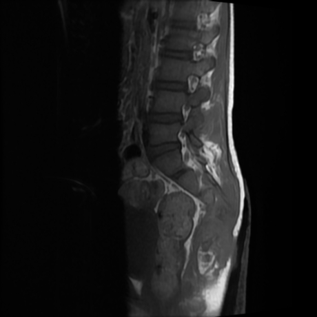 File:Cerebral and spinal tuberculosis (Radiopaedia 90489-107912 Sagittal T1 7).jpg