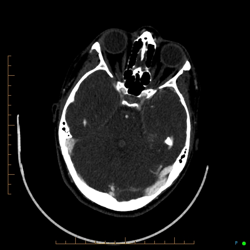 Cerebral arteriovenous malformation (AVM) (Radiopaedia 78162-90706 Axial CTA 101).jpg