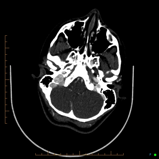 Cerebral arteriovenous malformation (AVM) (Radiopaedia 78162-90706 Axial CTA 65).jpg