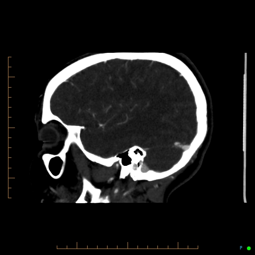 Cerebral arteriovenous malformation (AVM) (Radiopaedia 78162-90706 Sagittal CTA 60).jpg