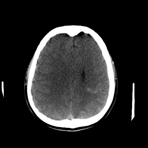 Cerebral arteriovenous malformation (Radiopaedia 28518-28759 Axial non-contrast 49).jpg