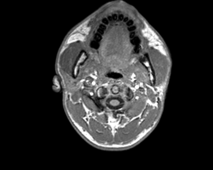 Cerebral arteriovenous malformation (Radiopaedia 30198-30813 Axial T1 56).jpg