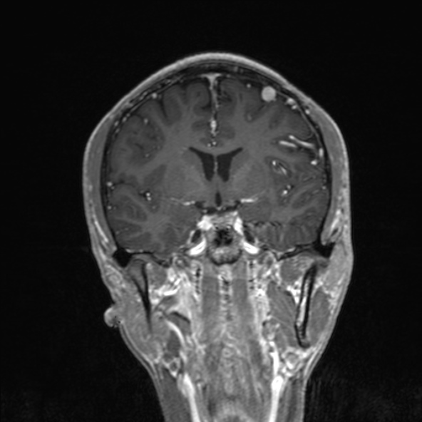Cerebral arteriovenous malformation (Radiopaedia 30198-30813 F 28).jpg