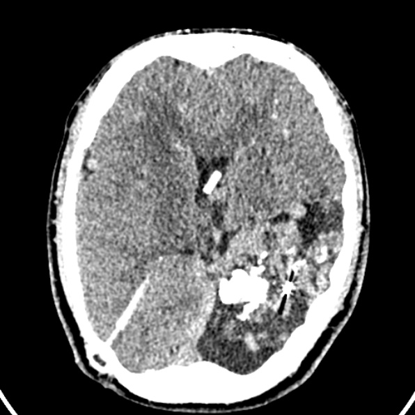 File:Cerebral arteriovenous malformation (Radiopaedia 37182-39012 Axial non-contrast 27).jpg