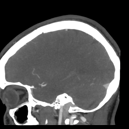 Cerebral arteriovenous malformation (Radiopaedia 39259-41505 Sagittal 43).png