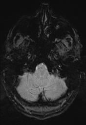 File:Cerebral arteriovenous malformation (Radiopaedia 55798-62372 Axial SWI 5).png