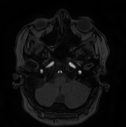 Cerebral arteriovenous malformation (Radiopaedia 74411-85654 Axial MRA 8).jpg