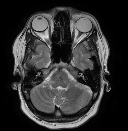 File:Cerebral arteriovenous malformation (Radiopaedia 74411-85654 Axial T2 5).jpg