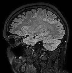 Cerebral arteriovenous malformation (Radiopaedia 74411-85654 Sagittal FLAIR 35).jpg