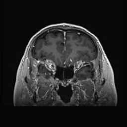 Cerebral arteriovenous malformation (Radiopaedia 84015-99245 Coronal T1 C+ 43).jpg