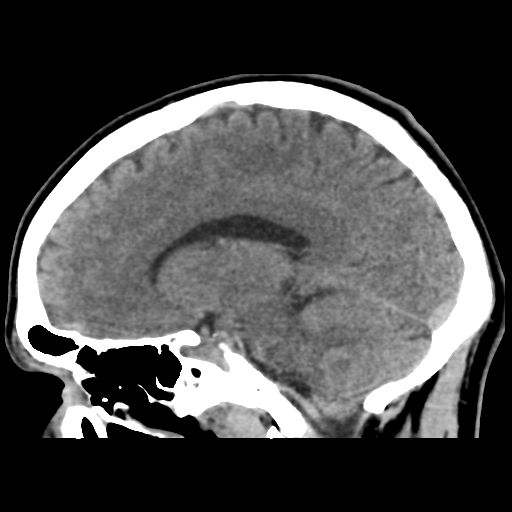 File:Cerebral arteriovenous malformation (Spetzler-Martin grade 2) (Radiopaedia 41262-44076 A 29).png