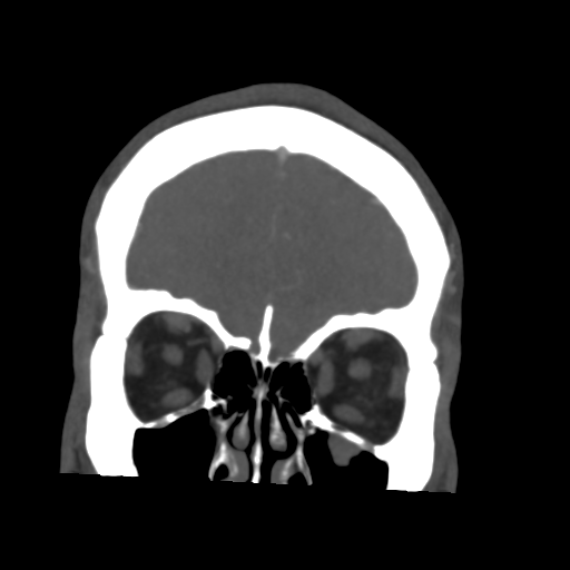 File:Cerebral arteriovenous malformation (Spetzler-Martin grade 2) (Radiopaedia 41262-44076 F 12).png