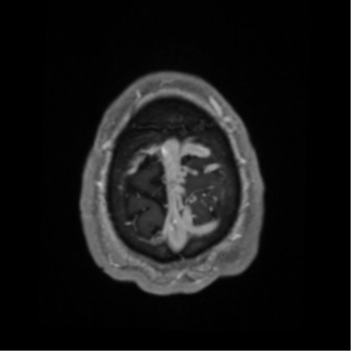 Cerebral arteriovenous malformation - huge (Radiopaedia 35734-37272 Axial T1 C+ 70).png