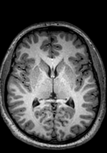 Cerebral arteriovenous malformation at posterior body of corpus callosum (Radiopaedia 74111-84925 Axial T1 142).jpg