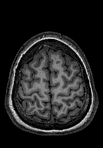 Cerebral arteriovenous malformation at posterior body of corpus callosum (Radiopaedia 74111-84925 Axial T1 34).jpg