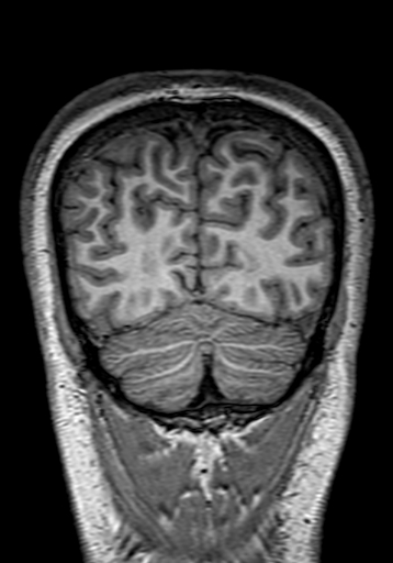 Cerebral arteriovenous malformation at posterior body of corpus callosum (Radiopaedia 74111-84925 Coronal T1 298).jpg