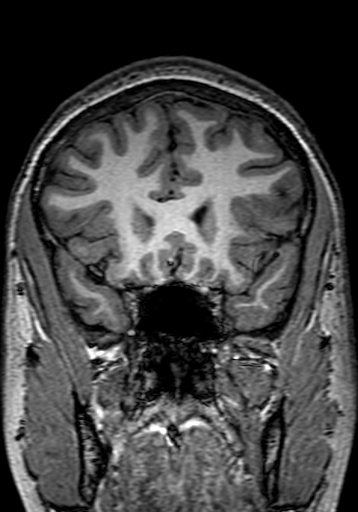 File:Cerebral arteriovenous malformation at posterior body of corpus callosum (Radiopaedia 74111-84925 Coronal T1 93).jpg
