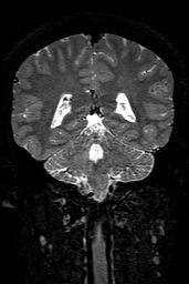 Cerebral arteriovenous malformation at posterior body of corpus callosum (Radiopaedia 74111-84925 Coronal T2 118).jpg