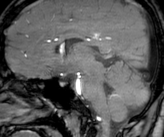 Cerebral arteriovenous malformation at posterior body of corpus callosum (Radiopaedia 74111-84925 J 185).jpg