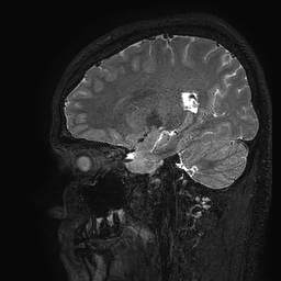 Cerebral arteriovenous malformation at posterior body of corpus callosum (Radiopaedia 74111-84925 Sagittal T2 90).jpg