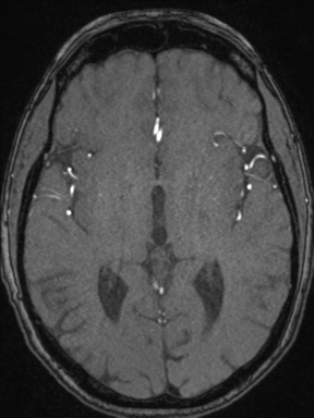Cerebral arteriovenous malformation with hemorrhage (Radiopaedia 34422-35737 Axial MRA 41).png