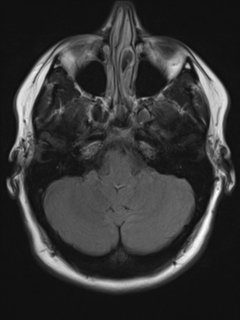 File:Cerebral cavernoma and development venous anomaly (Radiopaedia 37603-39482 Axial FLAIR 5).png