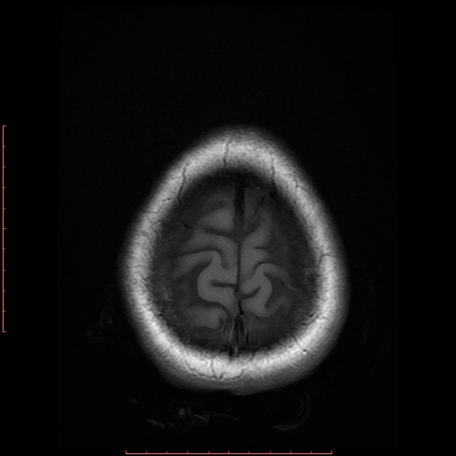 File:Cerebral cavernous malformation (Radiopaedia 26177-26306 Axial T1 20).jpg